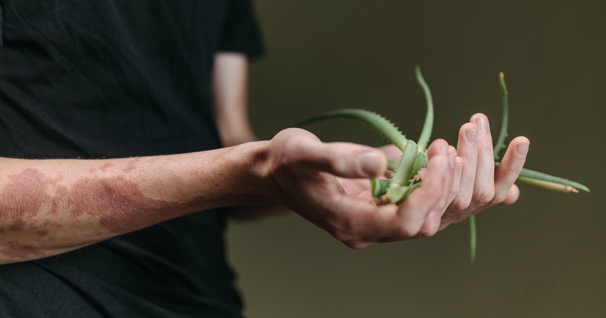 Aloes na oparzenia słoneczne - pierwsza pomoc dla podrażnionej skóry